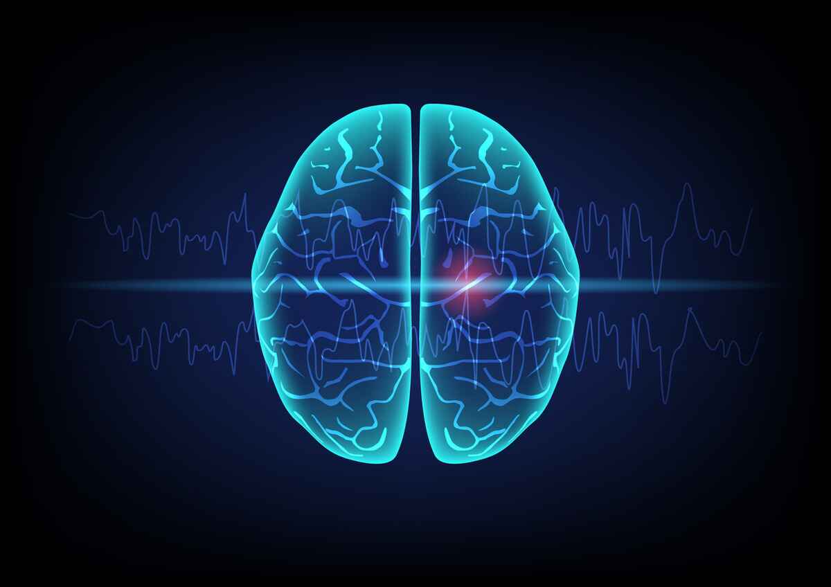 A seizure is the result of an abnormal electrical impulse in the brain